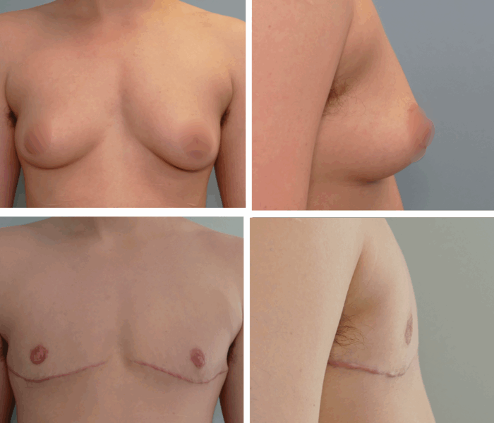 Before and after chest masculinization by Dr. Tina Jenq in Portland