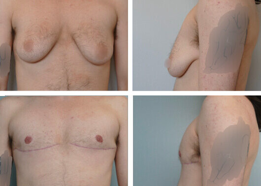 Top Surgery Before and After Dr. Jenq
