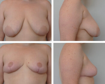 Breast Lift Before and After Dr Jenq