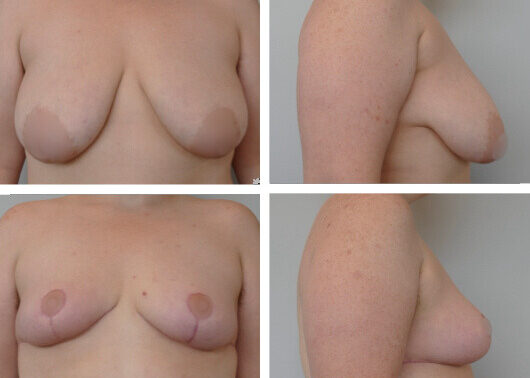 Breast Lift Before and After Dr Jenq