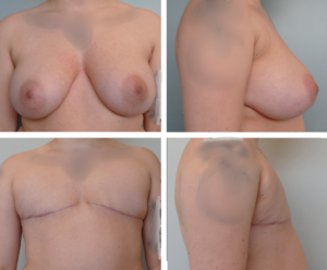 Top Surgery Portland by Dr. Tina Jenq