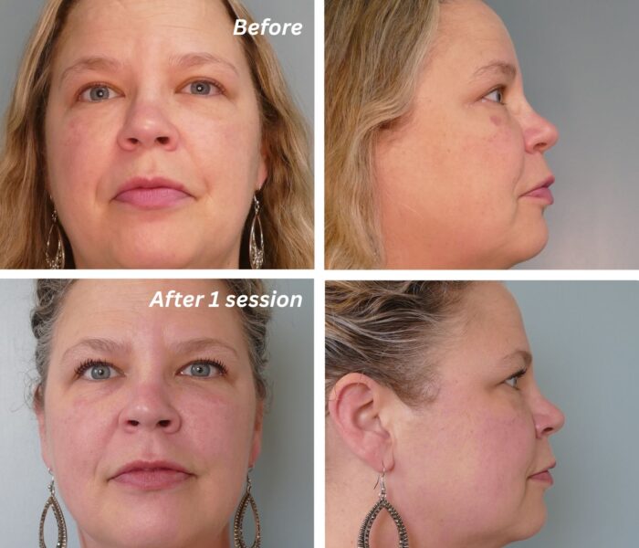CO2 laser solution Before and After Dr. Jenq
