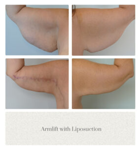 Armlift Before and After Portland OR Metro