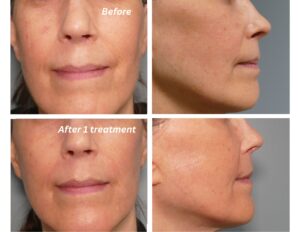 CO2 laser solution Before and After Dr. Jenq