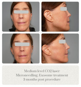 Laser Skin Solution Portland OR Metro