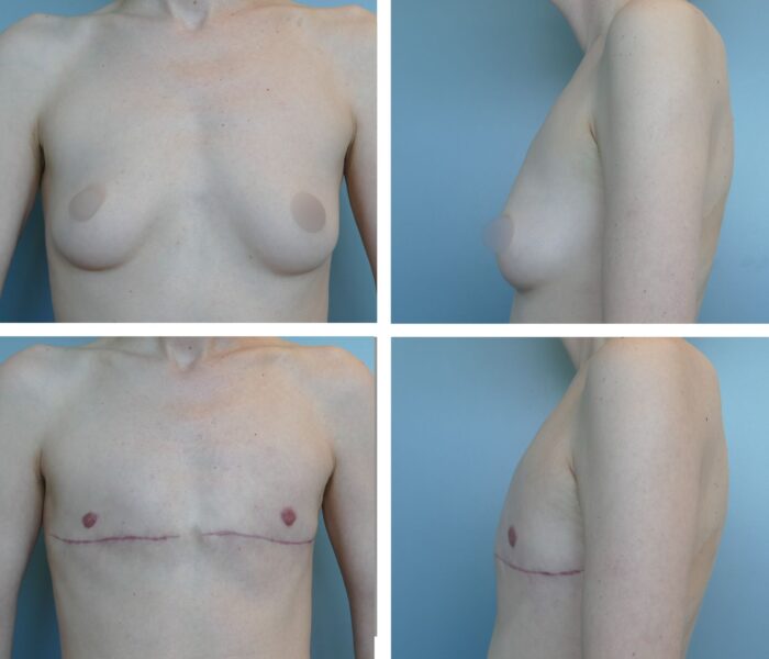 Top surgery before and after Dr. Jenq