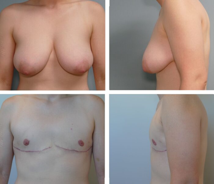 Top surgery before and after Dr. Jenq