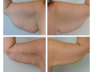 Armlift Portland Dr. Jenq