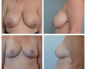 Breast reduction and lift Before and After Dr. Jenq Portland Oregon
