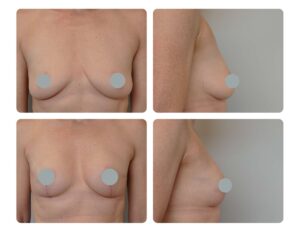 Breast lift Before and After