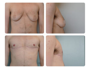 Top Surgery Before and After Dr. Jenq Plastic Surgery Portland OR Metro