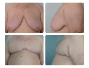 Double incision mastectomy Before and After Portland Plastic Surgery