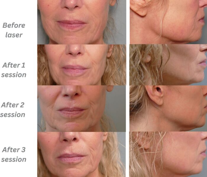 CO2 laser skin solution before and after Dr. Jenq