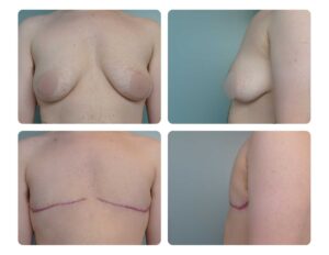 Top Surgery before and after Oregon Plastic Surgery Dr. Tina Jenq