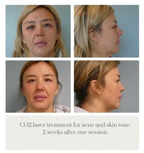 CO2 laser skin resurfacing for acne at Oregon Plastic Surgery