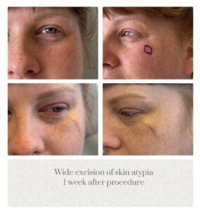Excision skin atypia face Dr. Tina Jenq Portland Plastic Surgeon
