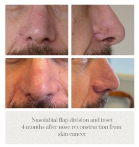 Nose reconstruction before and after Oregon Plastic Surgery Dr. Tina Jenq