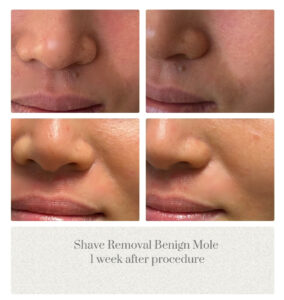 Shave Removal Face Mole Dr. Jenq Portland Plastic Surgeon