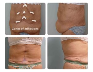Zones of Adhesion in Tummy Tuck
