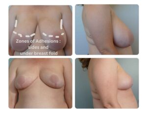 Zones of Adhesion in Breast Reduction