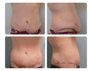 Tummy Tuck Before and After