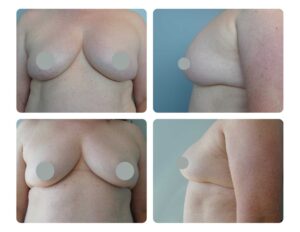 Breast implant removal