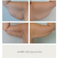 Armlift Before and After Portland OR Metro