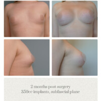 MTF breast augmentation plastic surgery in portland