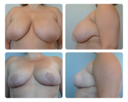 Breast reduction before and after Portland Oregon Plastic Surgery