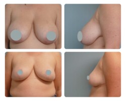 Breast reduction before and after
