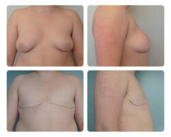 Top Surgery Portland OR Before and After