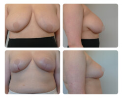 Plastic Surgery in Portland Breast Reduction Before and After