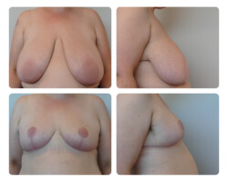 Breast Reduction Oregon Plastic Surgery