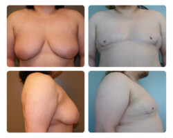 Top Surgery Before and After Plastic Surgery in Portland