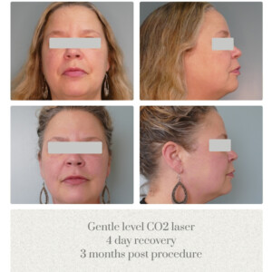 Laser Skin Solution Before and After Portland OR Metro