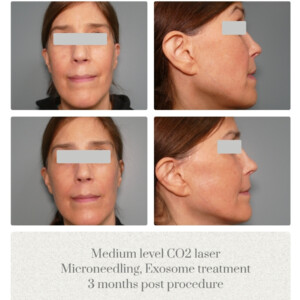 Laser Skin Solution Portland OR Metro