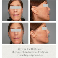 Laser Skin Solution Portland OR Metro