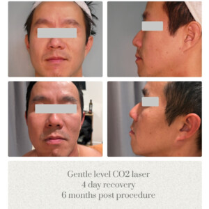 Laser skin solution before and after Dr. Jenq Portland Plastic Surgeon
