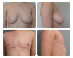 Top Surgery Before and After Portland Oregon Plastic Surgery