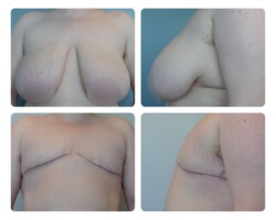 Top Surgery Before and After Plastic Surgery in Portland