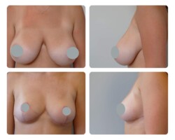 Before and After Breast Reduction