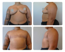 Conversion from breast reduction to top surgery before and after