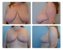 Breast reduction before and after plastic surgery in portland