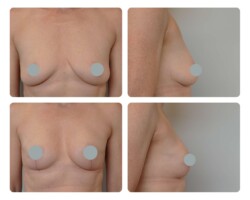 Breast lift Before and After