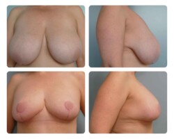 Breast reduction Before and After Dr. Jenq Portland Plastic Surgery