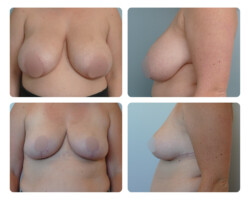 Breast Reduction with Breast Lift Before and After Dr. Jenq Plastic Surgeon Portland Metro