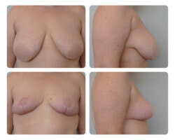 Breast Reduction and Breast Lift Before and After Portland Plastic Surgeon
