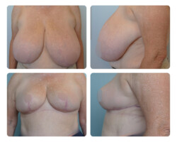 Breast Reduction and Breast Lift Before and After Portland Plastic Surgeon