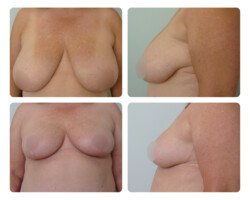 Breast Reduction Before and After Dr. Jenq Portland Metro Plastic Surgery
