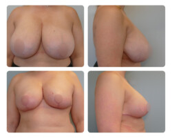 Breast Reduction Before and After Dr. Jenq Portland Metro Plastic Surgery